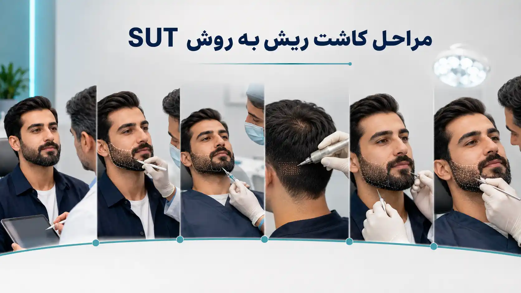مراحل کاشت ریش به روش SUT