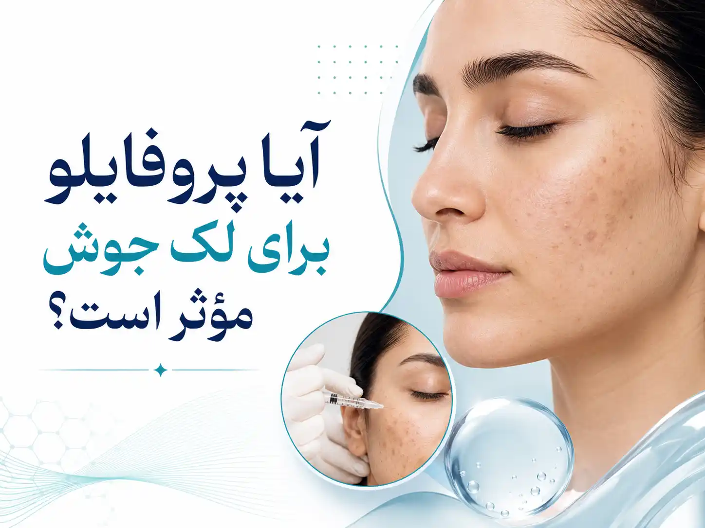 پروفایلو برای جای جوش، لک و آکنه؛ آیا واقعاً مؤثر است؟