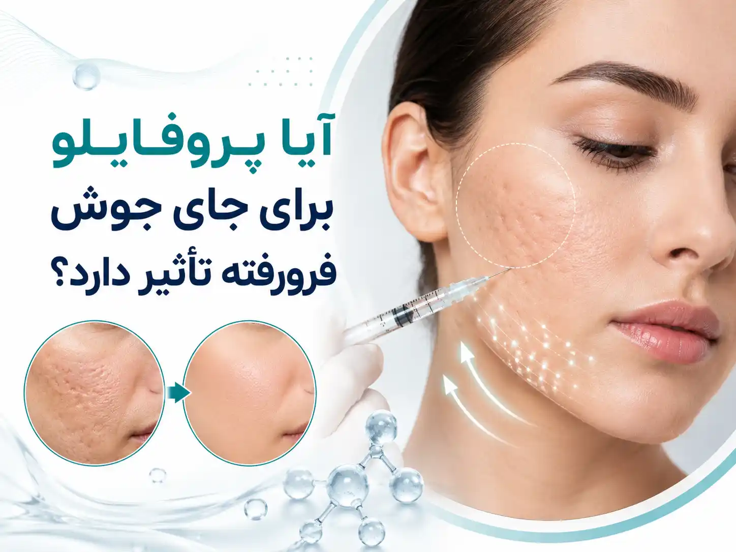 آیا پروفایلو برای جای جوش فرورفته تأثیر دارد؟