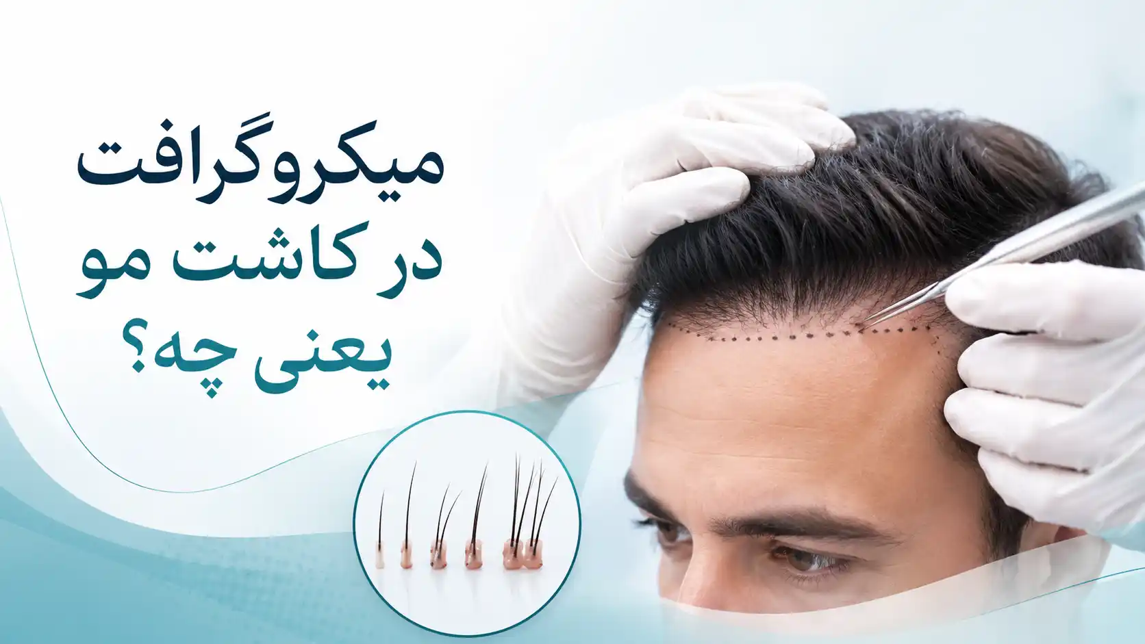 میکروگرافت در کاشت مو یعنی چه؟