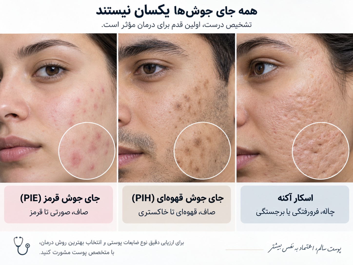 جای جوش قرمز یا قهوه‌ای؟ تفاوت PIE و PIH با اسکار و بهترین راه درمان
